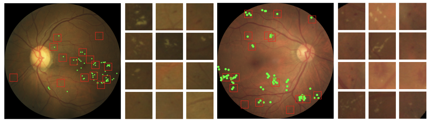 Sparse Activations for Interpretable Disease Grading